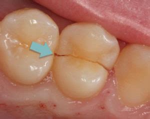 Is a Cracked Tooth Treatable? - Root Canal Treatment - Crown - Twinkle Family Dentalcare