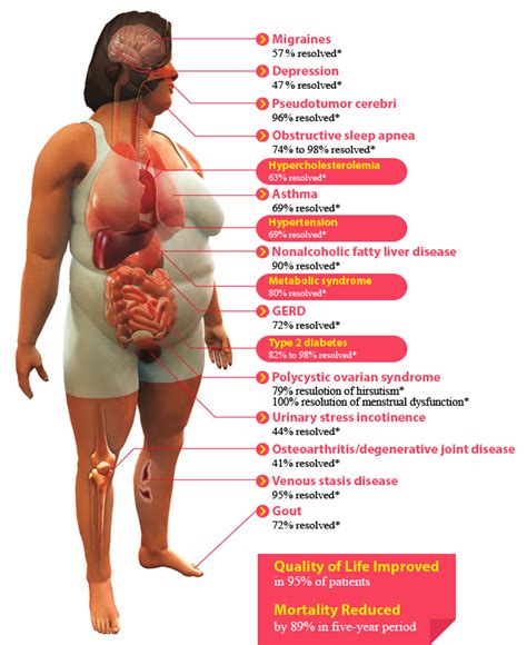 Pin on Bariatric surgery