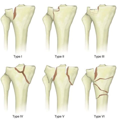 Tibial Plateau Fractures | Musculoskeletal Key