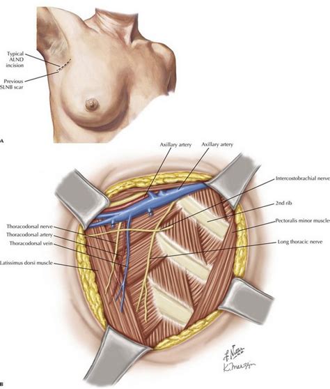 Axillary and Inguinal Lymphadenectomy | Basicmedical Key