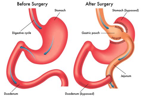 Gastric Bypass: What is Gastric Bypass? Gastric Bypass Surgery, UCLA, Los Angeles, Southern CA.