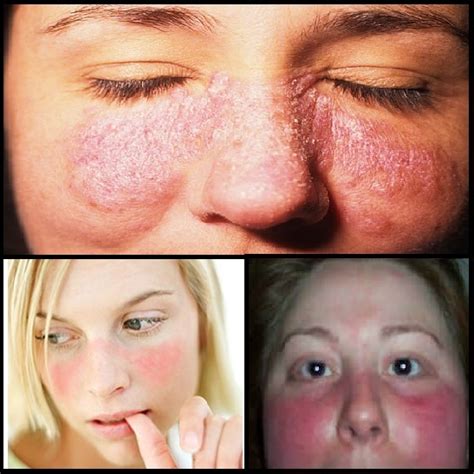 Lupus rash – Types, Effects, Diagnoses, Treatments, Prevention and Pictures | Drug Details