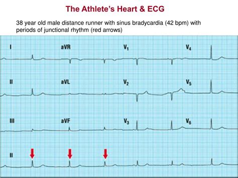 PPT - KINE 639 - Dr. Green Section 6 The Athlete’s Heart & ECG Reading in Conover: pages 253-271 ...