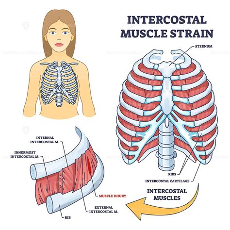 Intercostal muscle strain as muscular group in chest cavity outline ...