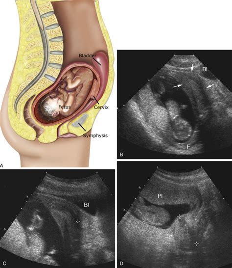 Ultrasound Evaluation of the Uterus | Radiology Key