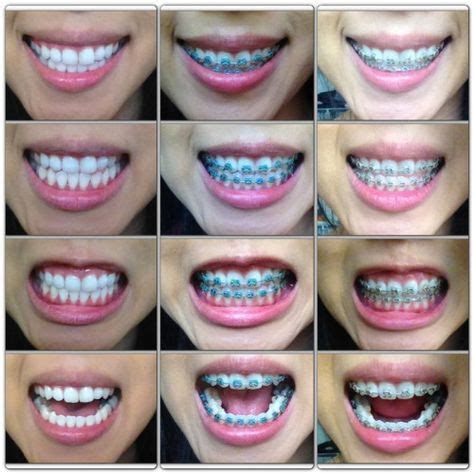 Braces | Teeth braces, Dental braces, Braces tips