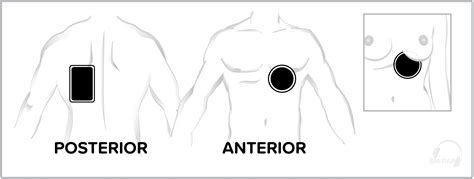 May 2023 - Transcutaneous Pacer Pad Placement - EM:RAP 2023 May | EM:RAP