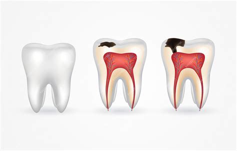 Caries dental y diente sano. caries superficial; caries profunda, caries de esmalte y dentina ...