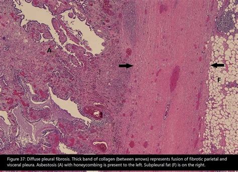 Visceral Pleura Histology