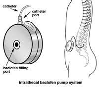 Pump: Baclofen Pump