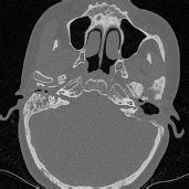 Axial CT scan of the temporal bone. | Download Scientific Diagram