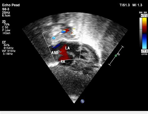 Two-dimensional echocardiogram image showing the atrial septal defect ...