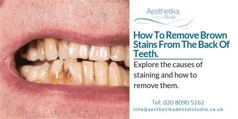 How To Remove Brown Stains from the Back of Teeth