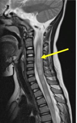 Acute transverse myelitis – Radiology Cases