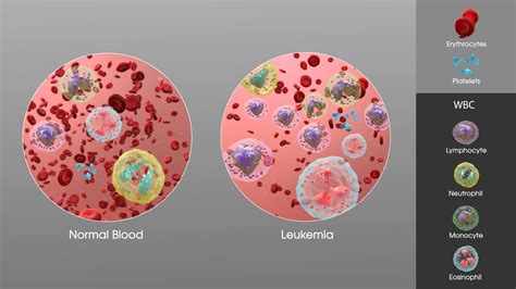 Leukemia - Types, Causes, Symptoms, Diagnosis, Treatment, Prevention ...