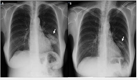 X-ray showing typical plain radiographic findings of aspergilloma A:... | Download Scientific ...