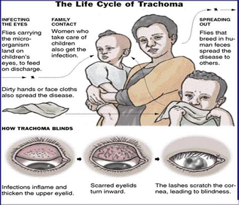 Trachoma - Causes, Symptoms, Treatment, Diagnosis and Prevention :: Galleria Community Health ...