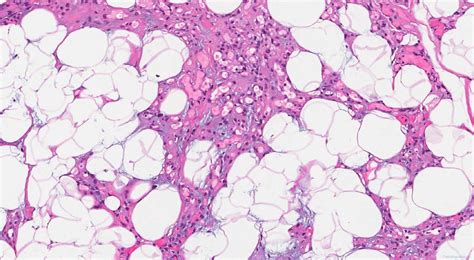 Angiomyolipoma | Ottawa Atlas of Pathology