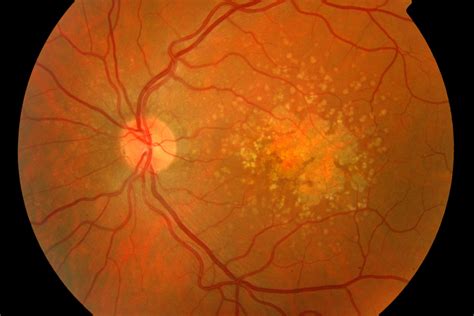 AMD - Age-related Macular Degeneration - Family Eyecare