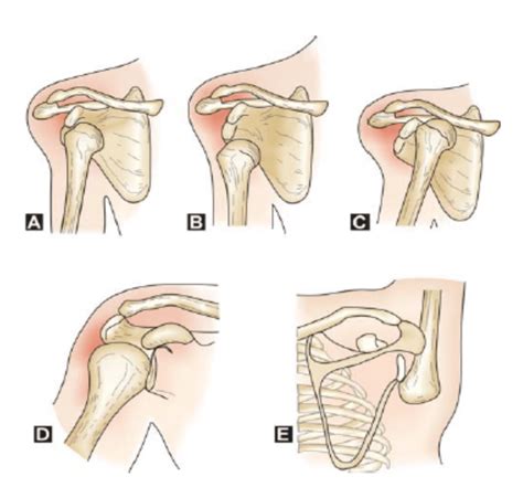 Dislocated Shoulder | Reflex Health