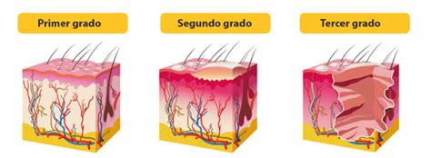 Quemaduras De Tercer Grado