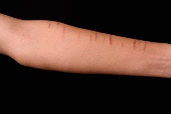 Cutting one’s skin is a cry for attention and help | MN Spokesman-Recorder