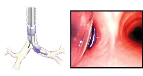 Placement of a Double-Lumen Endotracheal Tube | NEJM