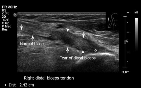 Ultrasound in the diagnosis of clinical orthopedics: The orthopedic ...