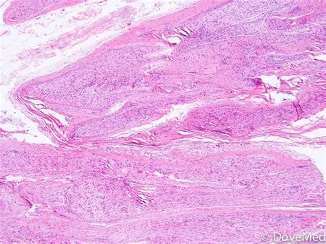 Colonic Arteriovenous Malformation - DoveMed