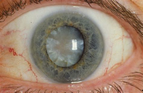 Cataract | A hypermature age-related cortico-nuclear catarac… | Flickr