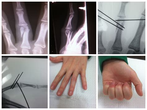 Finger Fracture Treatment with Percutaneous Pins - John Erickson, MD