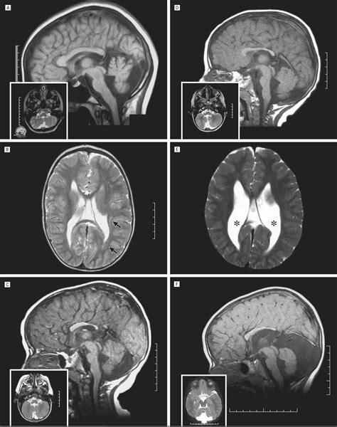 Cerebellar Ataxia With Progressive Improvement | Movement Disorders | JAMA Neurology | JAMA Network