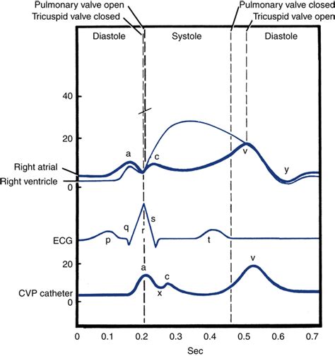 Central Venous Waveform