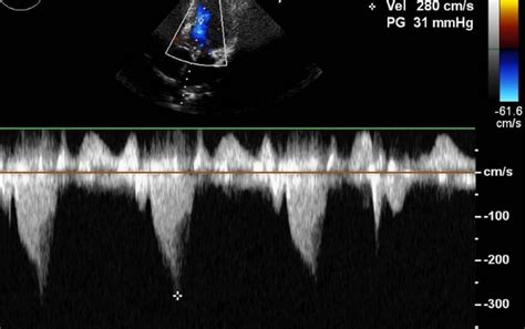 LVOT gradient in HOCM – Doppler echocardiogram – All About Cardiovascular System and Disorders