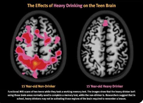 The Effects of Drinking on the Teenage Brain