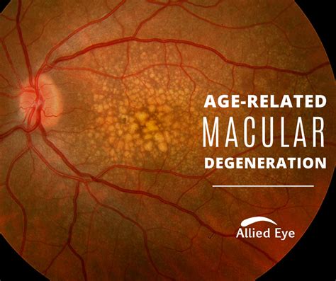 Age Related Macular Degeneration: Facts, Symptoms, & Treatment