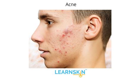 Acne: Symptoms, Causes, Treatments | LearnSkin