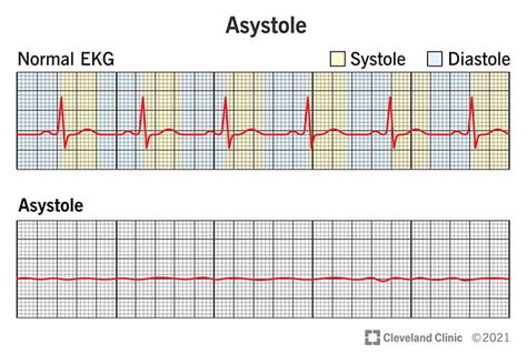 Pulseless Electrical Activity Vs Asystole