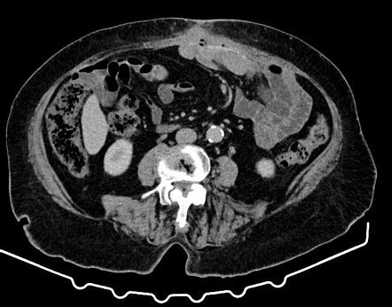 Enterocutaneous Fistula Ostomy