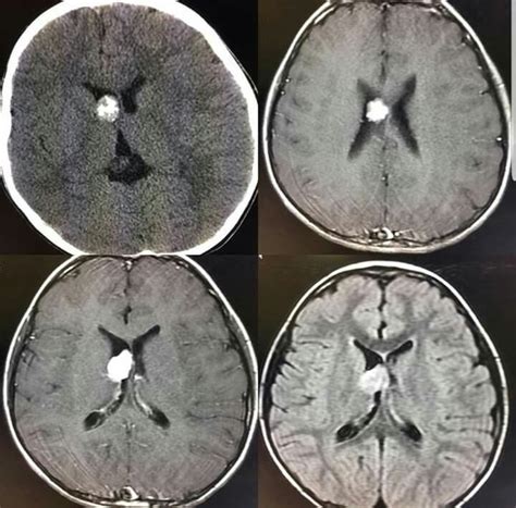 FINAL: CHOROID PLEXUS PAPILLOMA .. | Brain images, Radiology, Plexus products