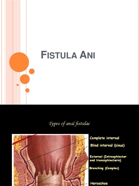 Fistula Ani