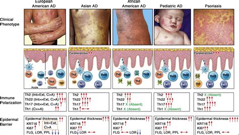 Atopic dermatitis endotypes and implications for targeted therapeutics ...