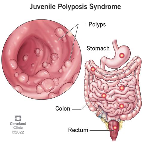 Gallbladder Polyp, Causes, Signs And Symptoms, Diagnosis, 52% OFF