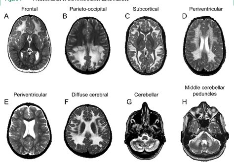 Figure 1 from An MRI-based approach to the diagnosis of white matter ...