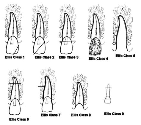 Ellis and Davey Classification of tooth fracture (1960)