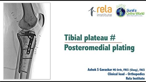 Posteromedial tibial plateau fixation - YouTube