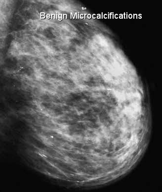 Breast Microcalcifications on mammogram - Moose and Doc