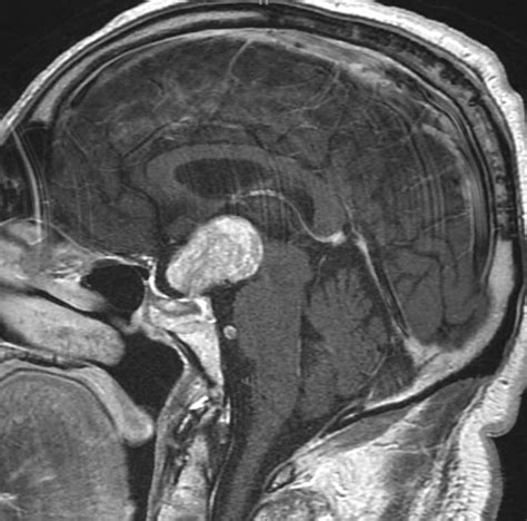 Pituitary Macroadenoma. - Neuro MR Case Studies - CTisus CT Scanning