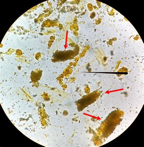 Urine Sediment of the Month: Pigmented Casts & What Those Pretty Colors Tell Us - Renal Fellow ...