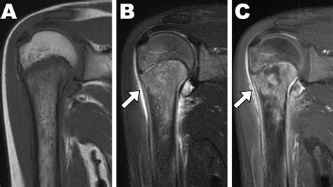 Subperiosteal Abscess with Pediatric Acute Osteomyelitis